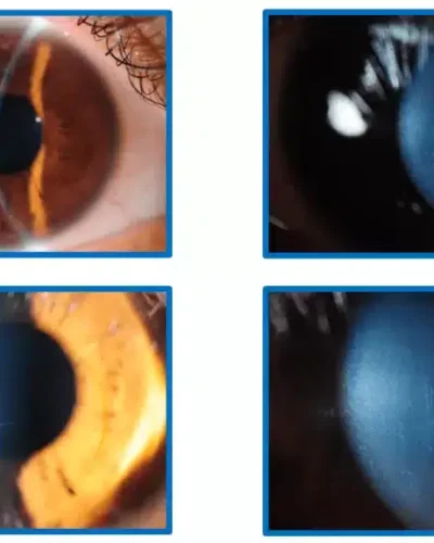 Clinical-signs-of-keratoconus-1024x576.png